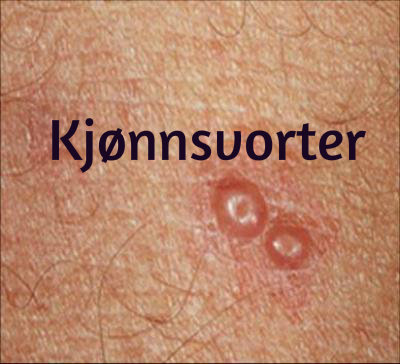 På penis vorter Fjernelse af